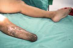 LegAmputated1